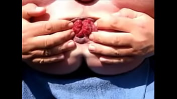 Ass Gape Extreme Monsterextrem Prolapse Asshole