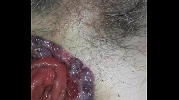 Fucking Dilated Prolapsed Ass With Vibe