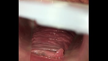 Gynecologic Speculum