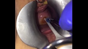 Cervix Extreme Gyno Play