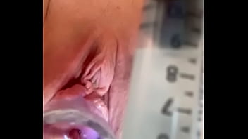 As Cervix Painfully Dilated W Catheter