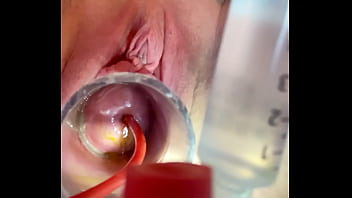W 4cc Inflation Of Catheter Balloon Inside Cervix