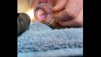 Advancing 6mm Sound In Cervix W Cramping