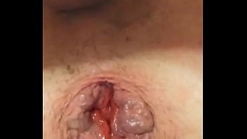 Solo Anal Prolapse N