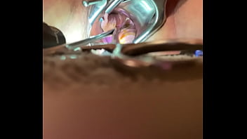 Internal View Of Orgasm W Sound Tenaculum And Vibrator