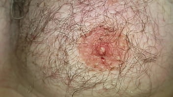 Foley Catheter And Safety-pins Extraction