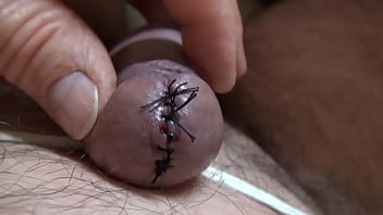 Couture De L_urètre