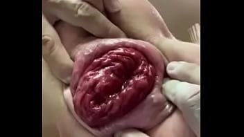 Fisting, Extreme-anal, Anal-stretching, Anal-prolaspe - Fisting - 2025 - Intense - Scene - Video 1663333