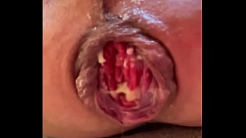 Aka Bianca My Prolapse