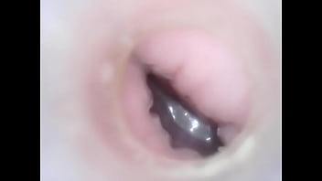 Endoscope In Urethra