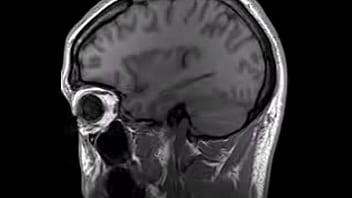 Structural Mri Animation